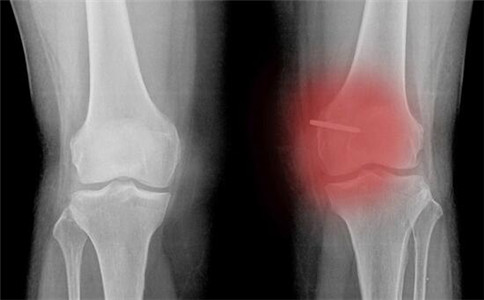 什么是骨性关节炎 骨性关节炎的病因 如何预防骨性关节炎